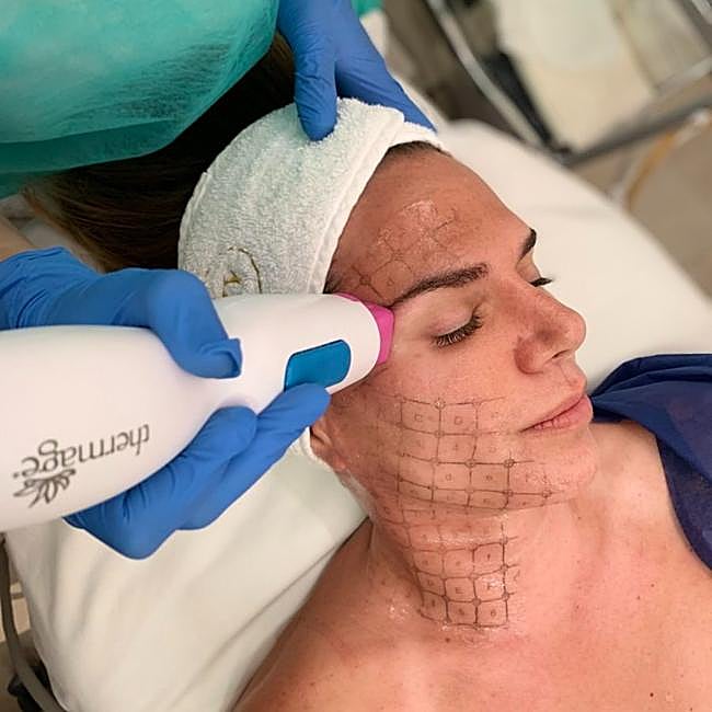 Tratamiento efecto flash de Maribel Yébenes.